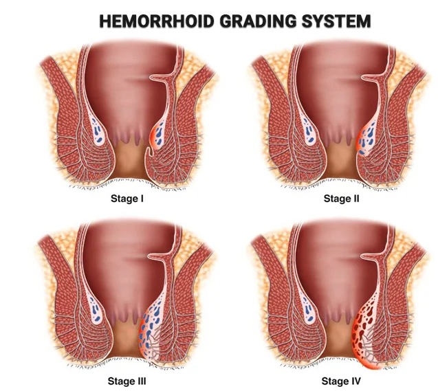 Goligher's Classification of Internal Hemorrhoids by Dr Parth Gajjar from Ahmedabad Gujarat India